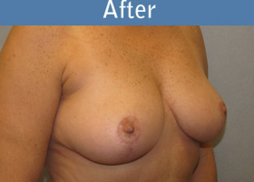 Milwaukee Plastic Surgery - Breast Reduction - 14-2