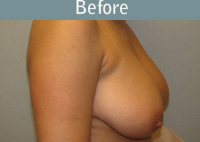 Milwaukee Plastic Surgery - Breast Reduction - 15-1