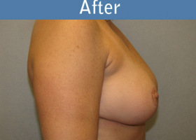 Milwaukee Plastic Surgery - Breast Reduction - 15-2