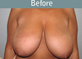 Milwaukee Plastic Surgery - Breast Reduction - 16-1