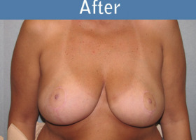 Milwaukee Plastic Surgery - Breast Reduction - 16-2