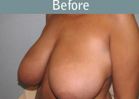 Milwaukee Plastic Surgery - Breast Reduction - 17-1