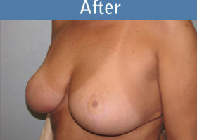 Milwaukee Plastic Surgery - Breast Reduction - 17-2