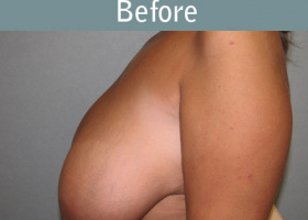 Milwaukee Plastic Surgery - Breast Reduction - 18-1