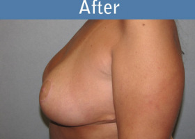 Milwaukee Plastic Surgery - Breast Reduction - 18-2
