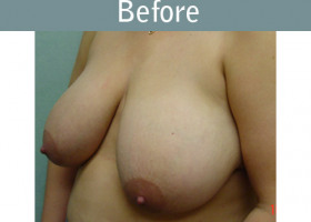 Milwaukee Plastic Surgery - Breast Reduction - 2-1