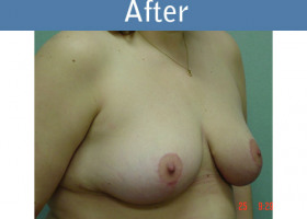 Milwaukee Plastic Surgery - Breast Reduction - 2-2