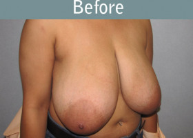 Milwaukee Plastic Surgery - Breast Reduction - 20-1