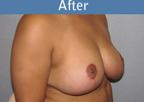 Milwaukee Plastic Surgery - Breast Reduction - 20-2