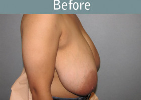 Milwaukee Plastic Surgery - Breast Reduction - 21-1