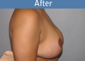 Milwaukee Plastic Surgery - Breast Reduction - 21-2