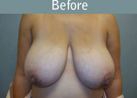 Milwaukee Plastic Surgery - Breast Reduction - 22-1