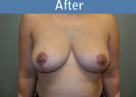 Milwaukee Plastic Surgery - Breast Reduction - 22-2