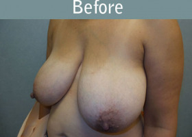 Milwaukee Plastic Surgery - Breast Reduction - 22-3