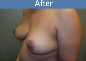 Milwaukee Plastic Surgery - Breast Reduction - 22-4