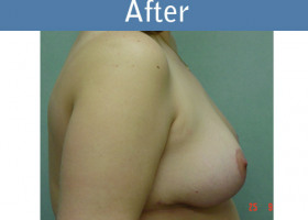 Milwaukee Plastic Surgery - Breast Reduction - 3-2