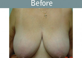 Milwaukee Plastic Surgery - Breast Reduction - 4-1