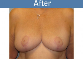 Milwaukee Plastic Surgery - Breast Reduction - 4-2