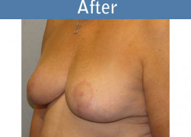 Milwaukee Plastic Surgery - Breast Reduction - 5-2