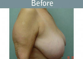 Milwaukee Plastic Surgery - Breast Reduction - 6-1