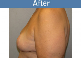Milwaukee Plastic Surgery - Breast Reduction - 6-2