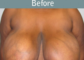 Milwaukee Plastic Surgery - Breast Reduction - 7-1