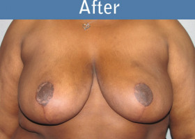 Milwaukee Plastic Surgery - Breast Reduction - 7-2