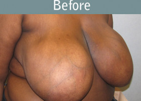 Milwaukee Plastic Surgery - Breast Reduction - 8-1