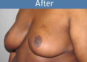 Milwaukee Plastic Surgery - Breast Reduction - 8-2