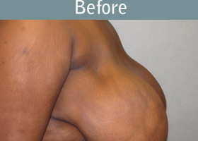 Milwaukee Plastic Surgery - Breast Reduction - 9-1