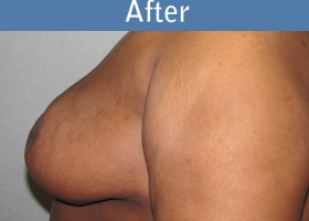 Milwaukee Plastic Surgery - Breast Reduction - 9-2