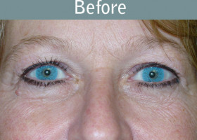 Milwaukee Plastic Surgery - Endoscopic Brow Lift - 1-1