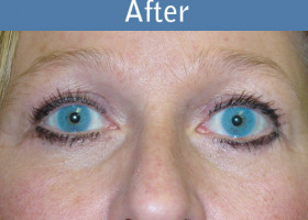 Milwaukee Plastic Surgery - Endoscopic Brow Lift - 1-2