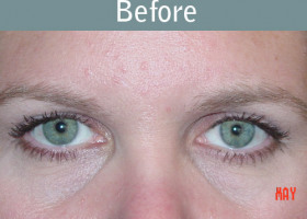 Milwaukee Plastic Surgery - Endoscopic Brow Lift - 2-1