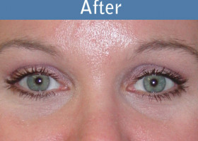 Milwaukee Plastic Surgery - Endoscopic Brow Lift - 2-2