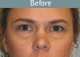 Milwaukee Plastic Surgery - Endoscopic Brow Lift - 3-1