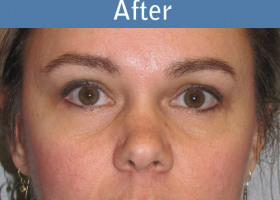 Milwaukee Plastic Surgery - Endoscopic Brow Lift - 3-2