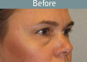 Milwaukee Plastic Surgery - Endoscopic Brow Lift - 4-1