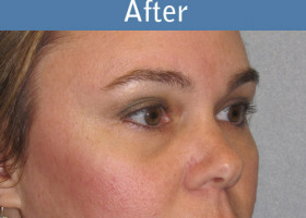 Milwaukee Plastic Surgery - Endoscopic Brow Lift - 4-2