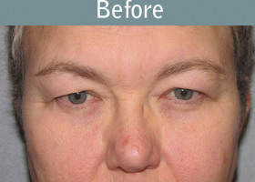 Milwaukee Plastic Surgery - Endoscopic Brow Lift - 5-1