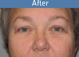 Milwaukee Plastic Surgery - Endoscopic Brow Lift - 5-2