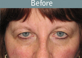 Milwaukee Plastic Surgery - Endoscopic Brow Lift - 6-1