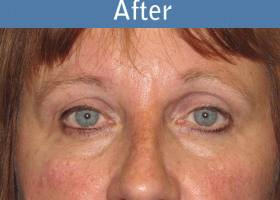 Milwaukee Plastic Surgery - Endoscopic Brow Lift - 6-2