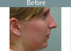 Milwaukee Plastic Surgery - Chin Implant - 1-1