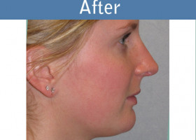 Milwaukee Plastic Surgery - Chin Implant - 1-2