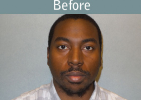 Milwaukee Plastic Surgery - Chin Implant - 2-1