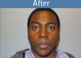 Milwaukee Plastic Surgery - Chin Implant - 2-2