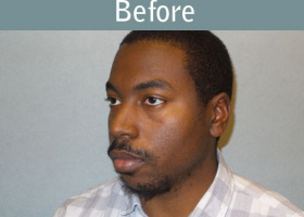 Milwaukee Plastic Surgery - Chin Implant - 2-3
