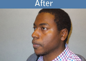Milwaukee Plastic Surgery - Chin Implant - 2-4