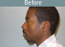 Milwaukee Plastic Surgery - Chin Implant - 2-5